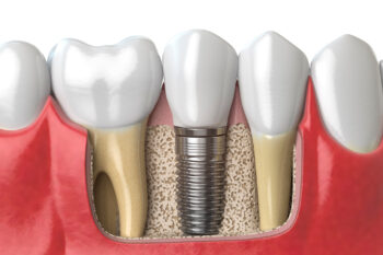 Dental Implants in Miami