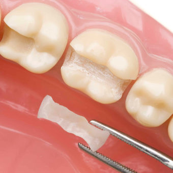Dental inlays & onlays