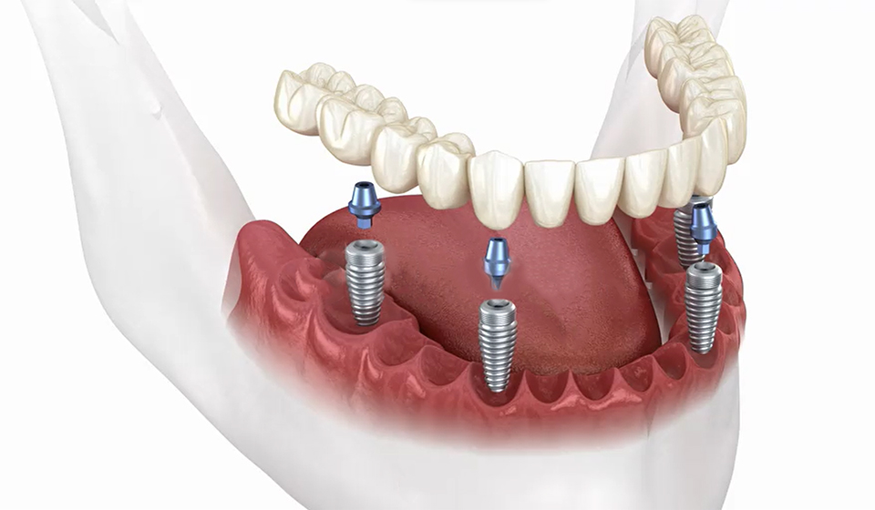 All-on-4 Dental Implants: How They Work & Their Advantages