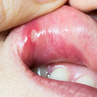 Mouth Ulcers in Miami