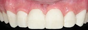 Teeth Whitening in Miami