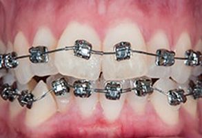 Dental Braces in Miami
