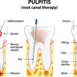 Root Canal Miami