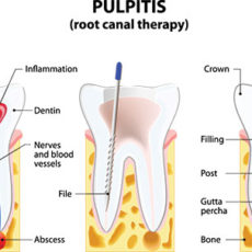Root Canal Miami