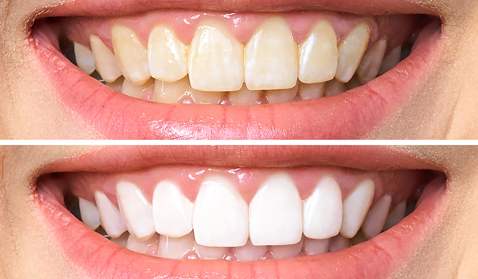 How Can I Maintain My Results After Teeth Whitening?