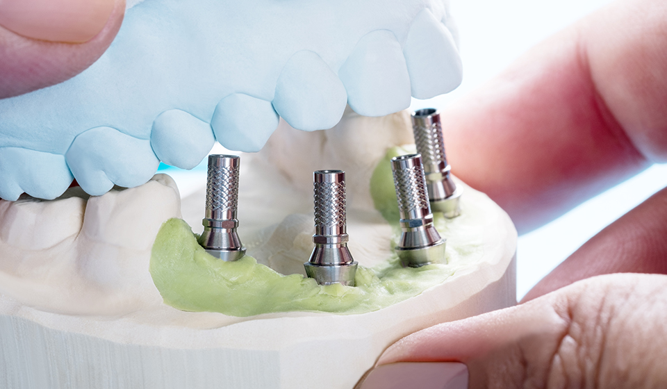 Permanent Teeth Replacement With all 4 dental implants